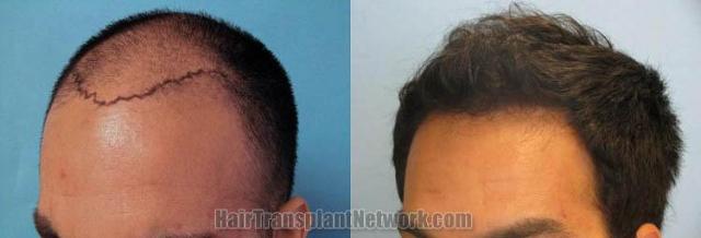 Hair transplantation surgery before and after images