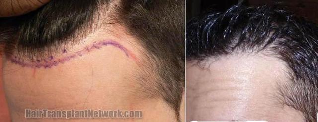 Hair transplantation surgery before and after images