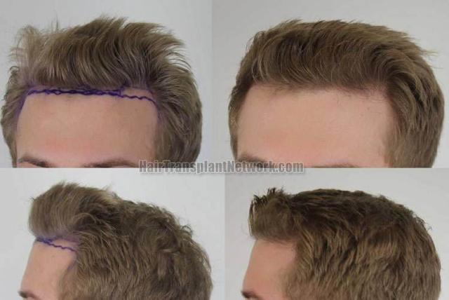 Hair transplantation surgery before and after pictures