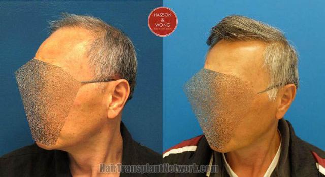 Hair transplantation surgery before and after pictures