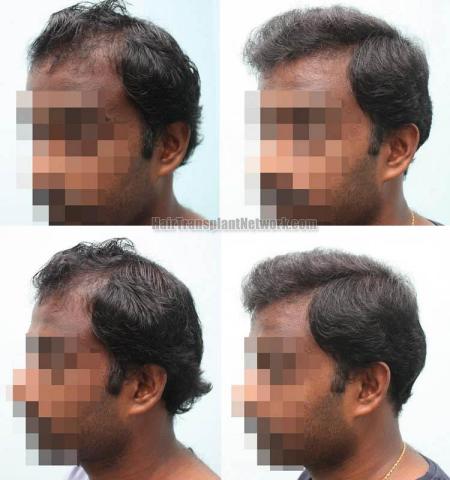 Hair transplantation surgery before and after pictures