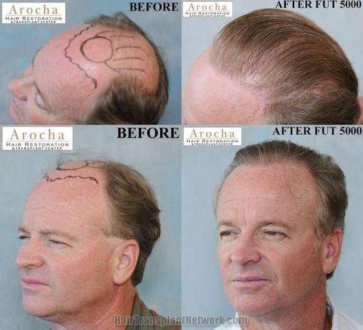 Hair transplantation surgery before and after images