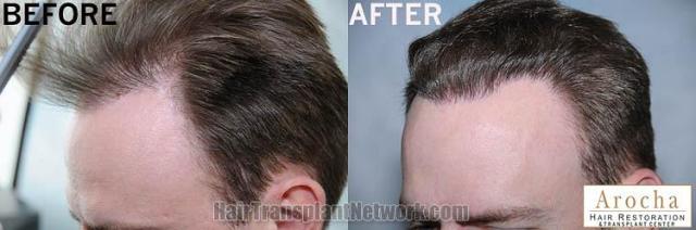 Hair transplantation surgery before and after images