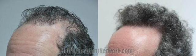 Hair transplantation surgery before and after pictures