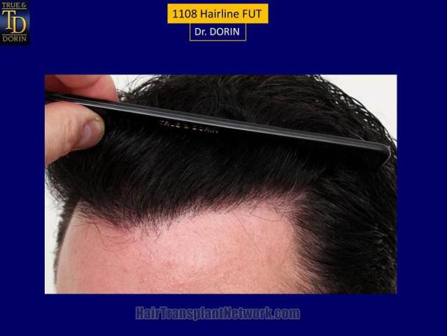 Hair restoration procedure before and after pictures