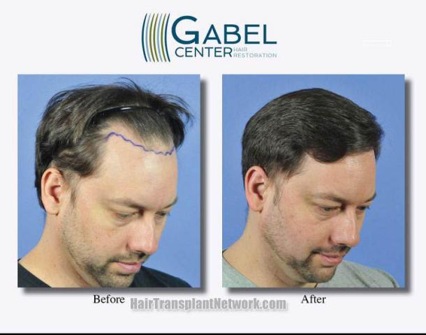 Hair transplantation surgery before and after images