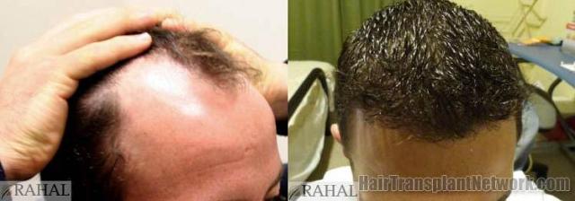 Hair transplantation surgery before and after photos