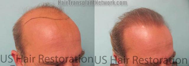 Hair transplantation surgery before and after images