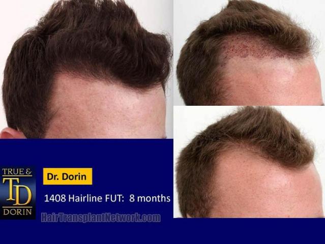 Hair restoration procedure before and after pictures