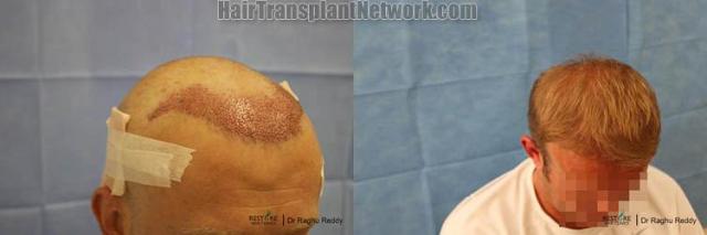 Hair restoration procedure before and after pictures