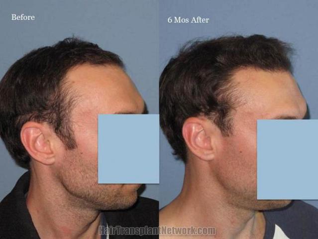 Hair restoration procedure before and after results