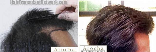 Hair restoration procedure before and after results