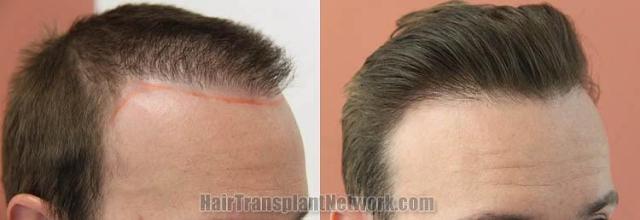 Hair transplantation surgery before and after images