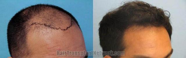 Hair transplantation surgery before and after photos