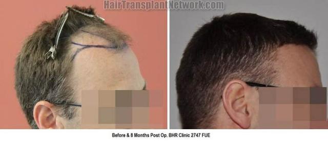 Hair transplantation surgery before and after pictures