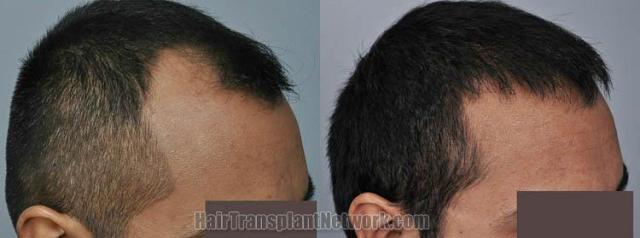 Hair transplantation surgery before and after images