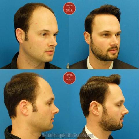 Hair restoration procedure before and after results