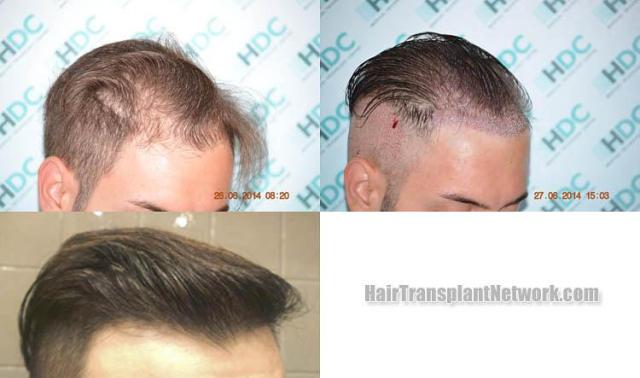 Hair transplantation surgery before and after photos