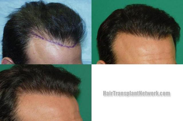 Hair transplantation surgery before and after images