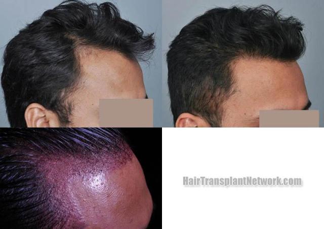 Hair restoration procedure before and after results