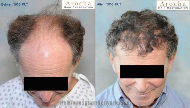 Hair transplantation surgery before and after images