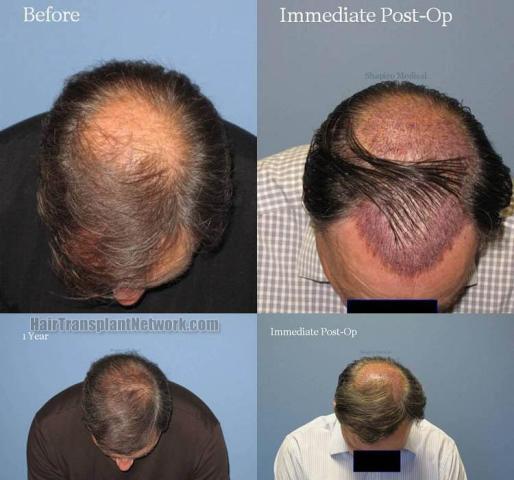 Top view before and after hair restoration results