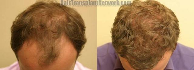 Top view before and after hair restoration results