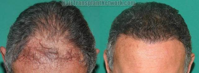 Hair transplantation surgery before and after photos