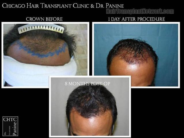 Hair restoration procedure before and after results