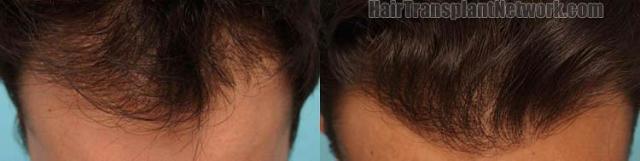 Hair transplantation surgery before and after photos