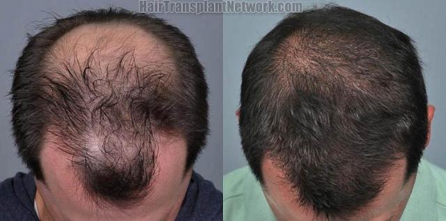 Hair transplantation surgery before and after photos