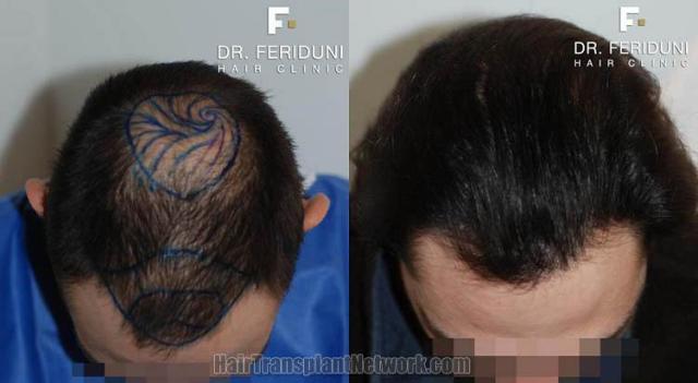 Hair transplantation surgery before and after photos