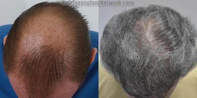 Hair transplantation surgery before and after photos