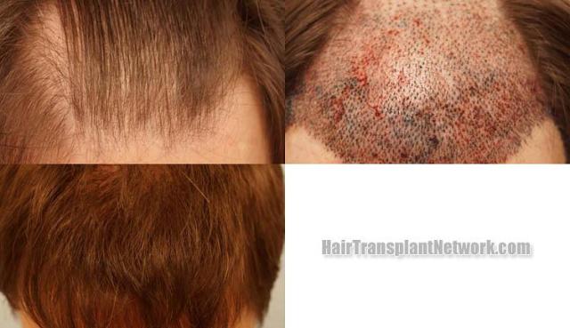 Top view before and after hair restoration results