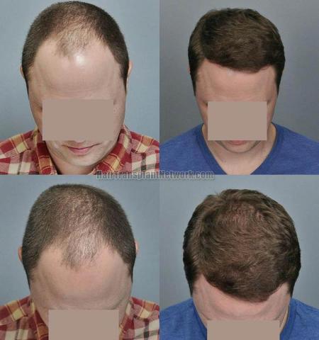 Top view - Before and after surgical hair replacement