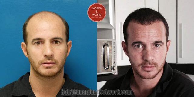 Hair transplantation surgery before and after photos