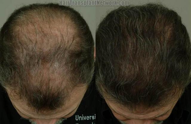 Top view - Before and after surgical hair replacement