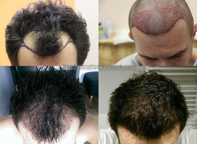 Top view before and after hair restoration results