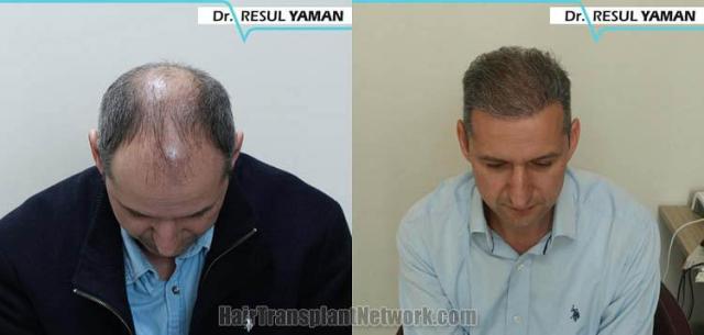 Top view before and after hair restoration results