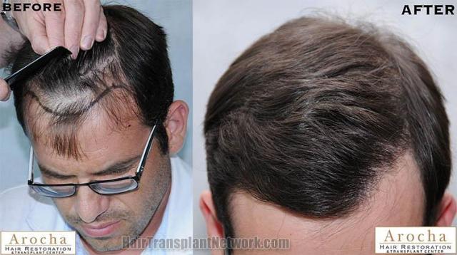 Top view before and after hair restoration results