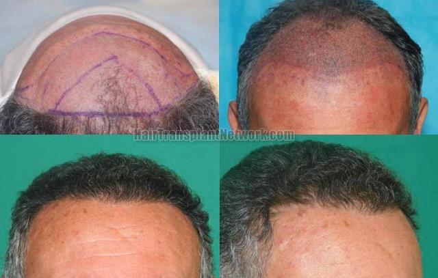 Hair restoration procedure before and after pictures