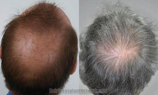 Hair restoration procedure before and after pictures