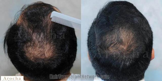 Hair transplantation surgery before and after images