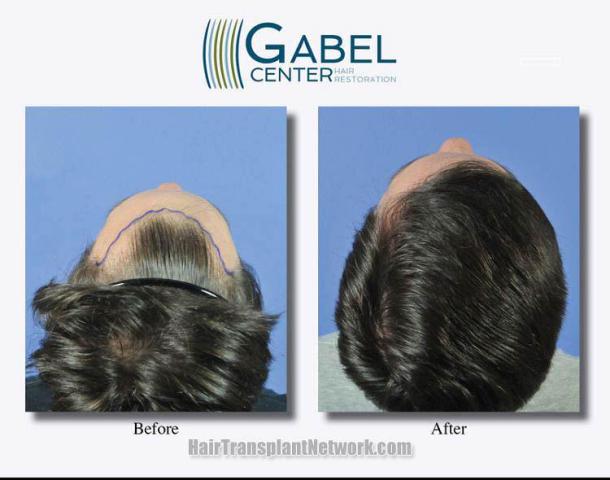 Hair restoration procedure before and after pictures