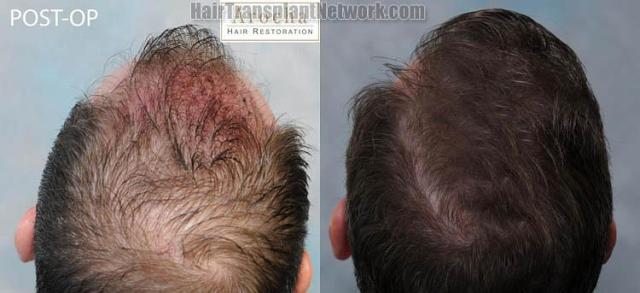 Hair restoration procedure before and after pictures