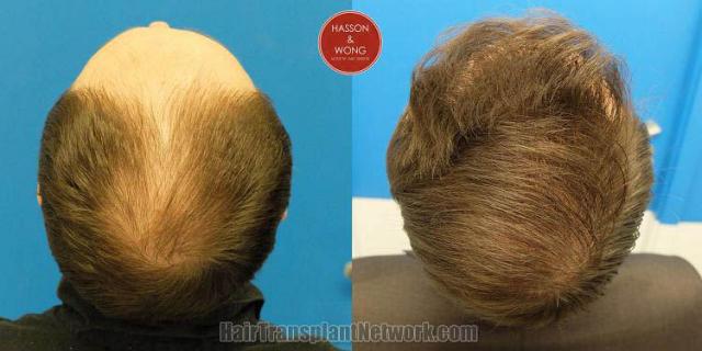 Hair transplantation surgery before and after images