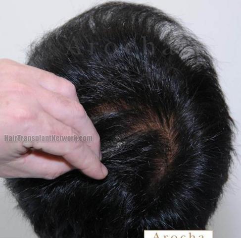 Hair transplantation surgery before and after pictures