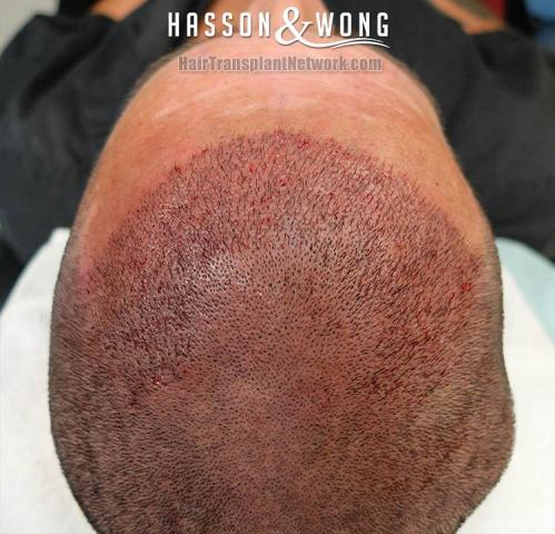 Hair restoration procedure before and after pictures