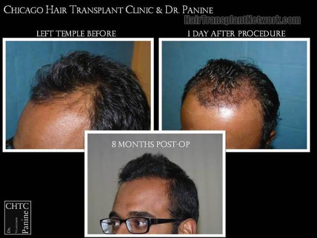 Hair transplantation surgery before and after images