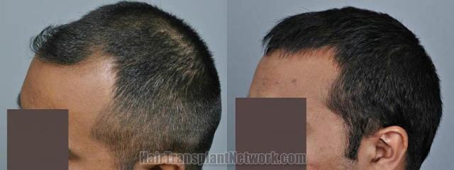 Hair transplantation surgery before and after pictures